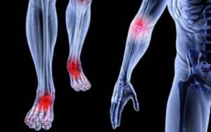 Saiba Como Diminuir a Dor da Artrite