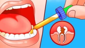 10 Dicas de Remédios Caseiros para Dor de Dente